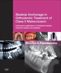 Skeletal Anchorage in Orthodontic Treatment of Class II Malocclusion: Contemporary Applications of Orthodontic Implants, Miniscrew Implants, and Mini Plates